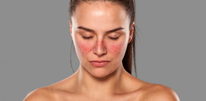 systemic lupus erythematosus