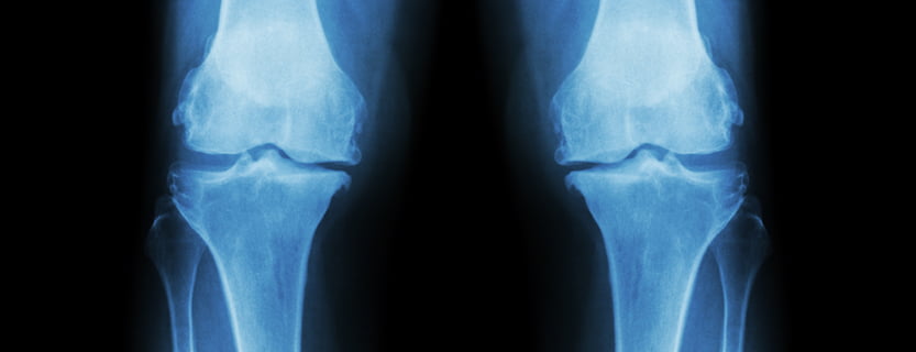 degenerative joint disease