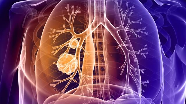 LUNG CANCER