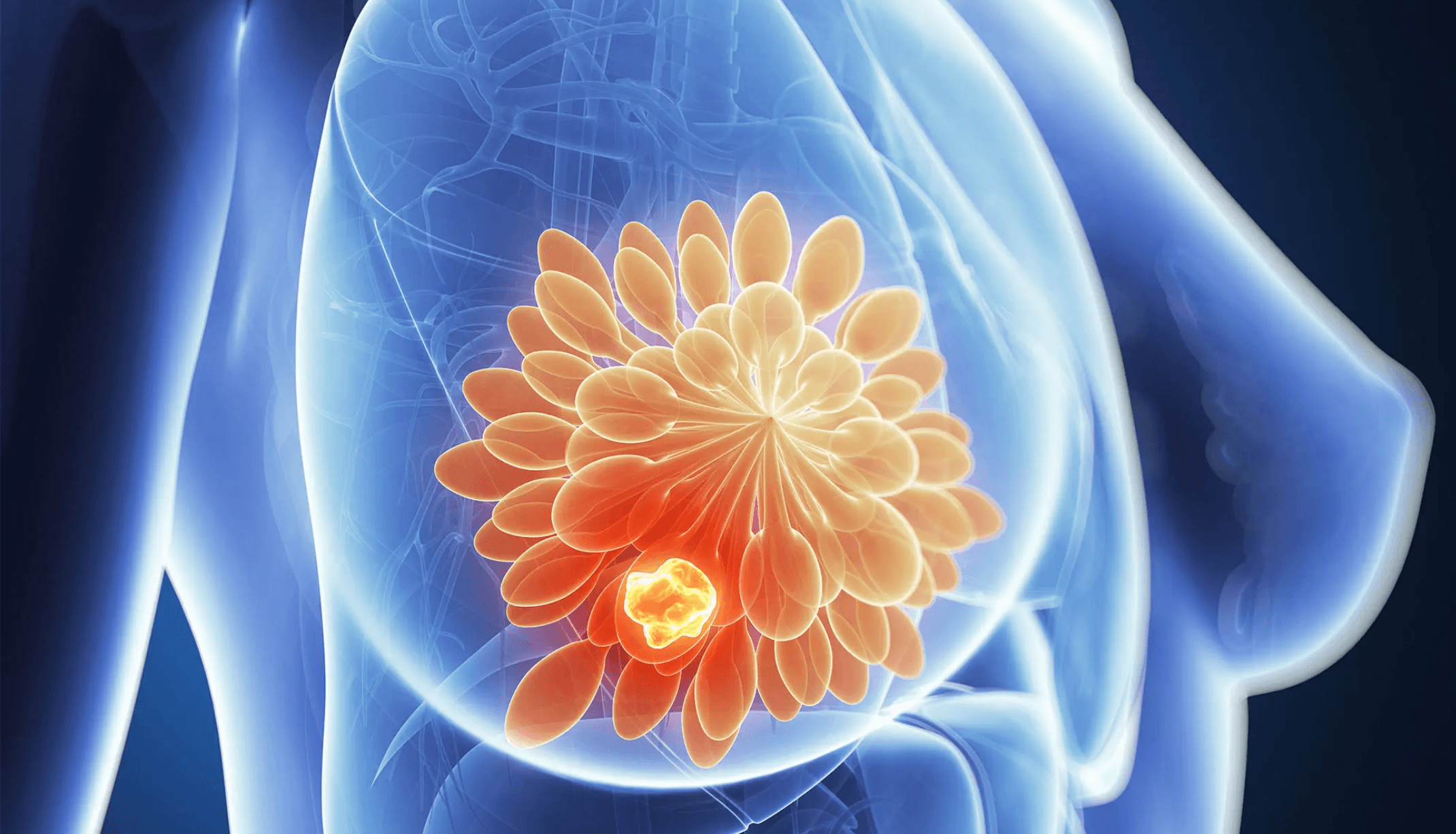 Breast cancer treatment