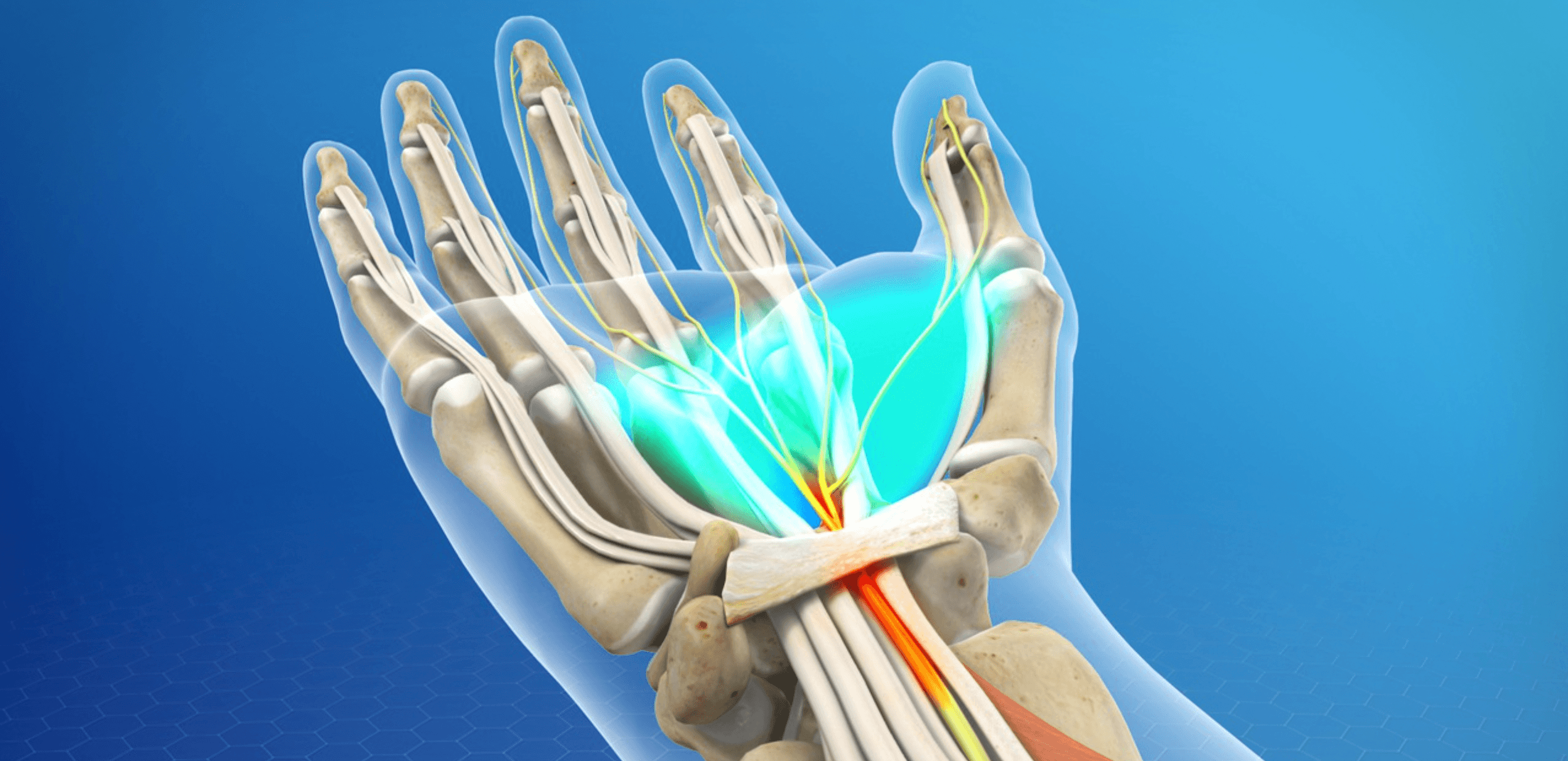 Carpal Tunnel Syndrome